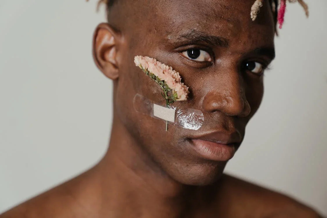 O que é a Acne, Causas, Tipos, Tratamentos e Dicas para Controlá-la